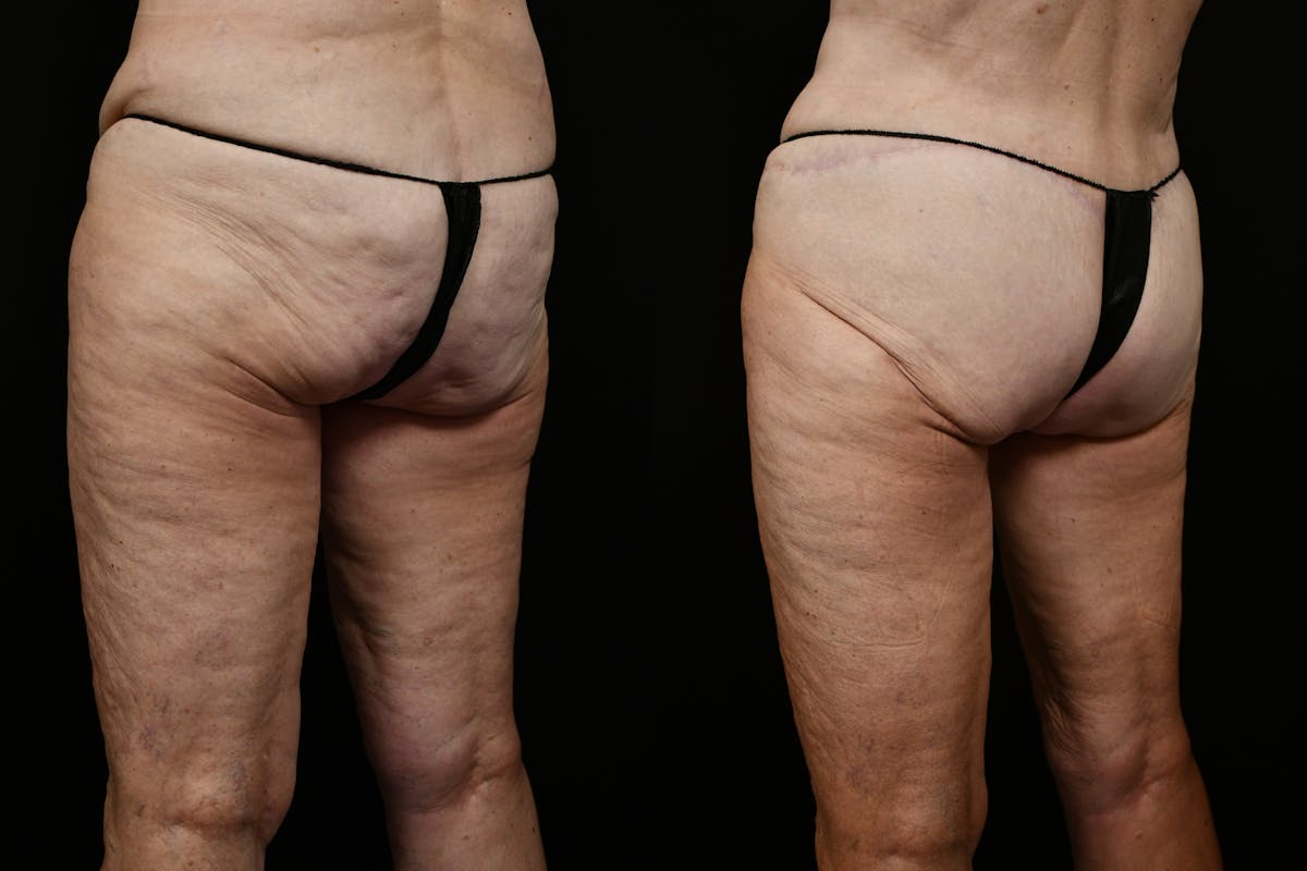 Thigh Lift Before & After Gallery - Patient 468934 - Image 2