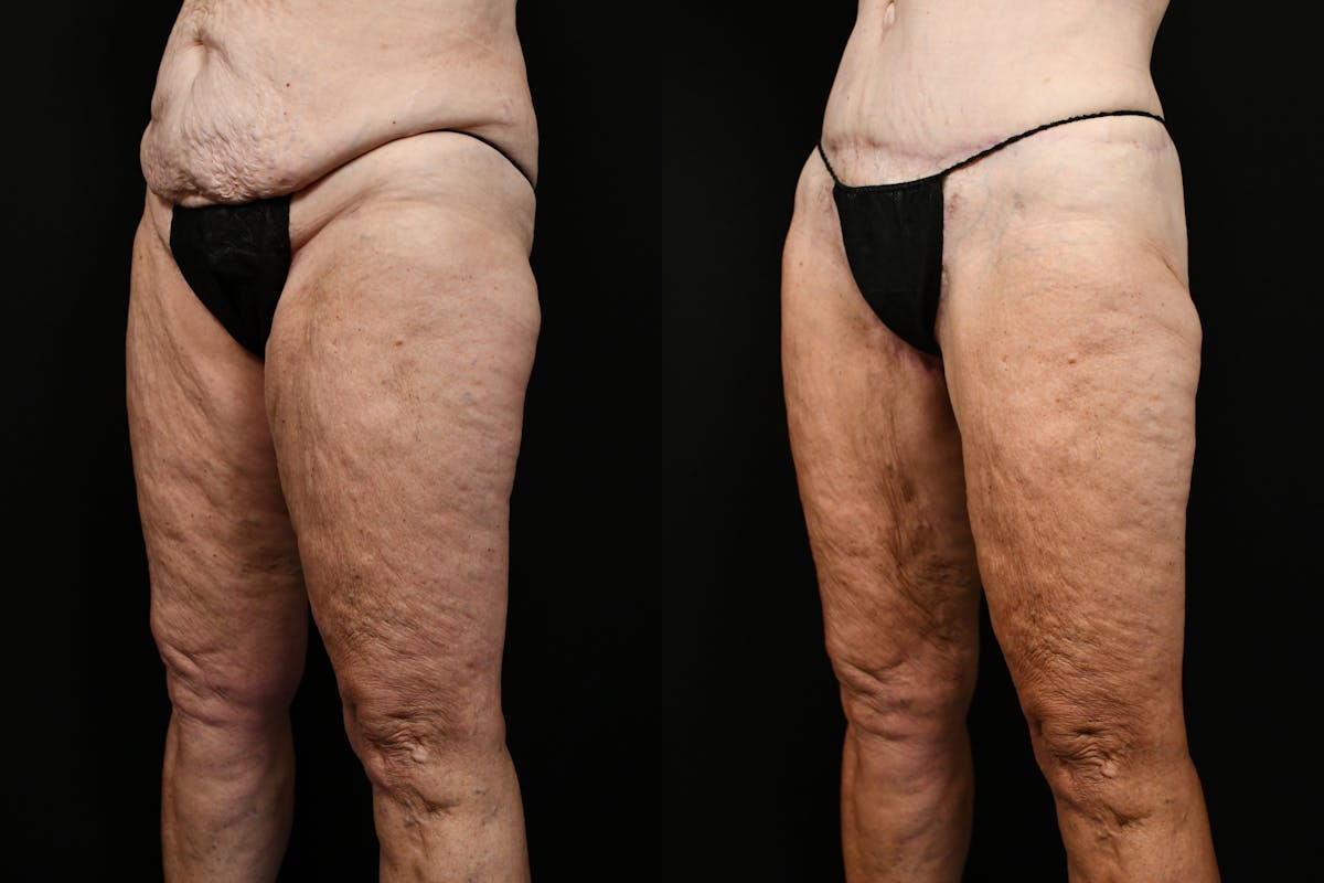 Thigh Lift Before & After Gallery - Patient 468934 - Image 4