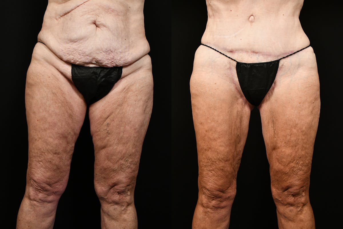 Thigh Lift Before & After Gallery - Patient 468934 - Image 5
