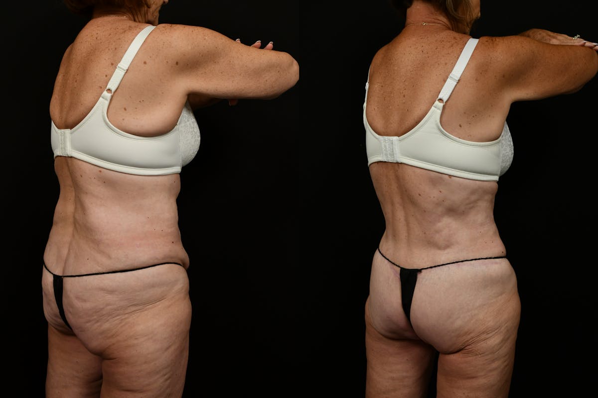 Tummy Tuck Before & After Gallery - Patient 258196 - Image 4