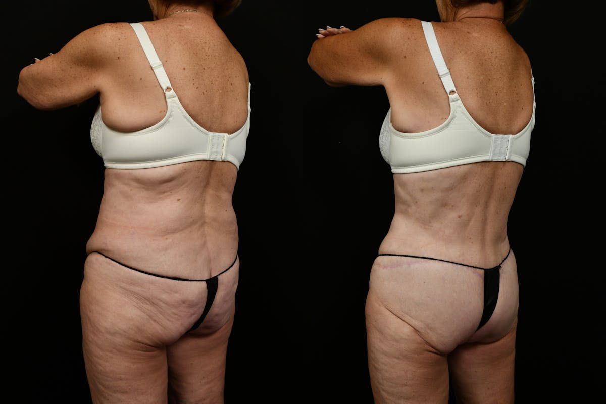 Tummy Tuck Before & After Gallery - Patient 258196 - Image 6