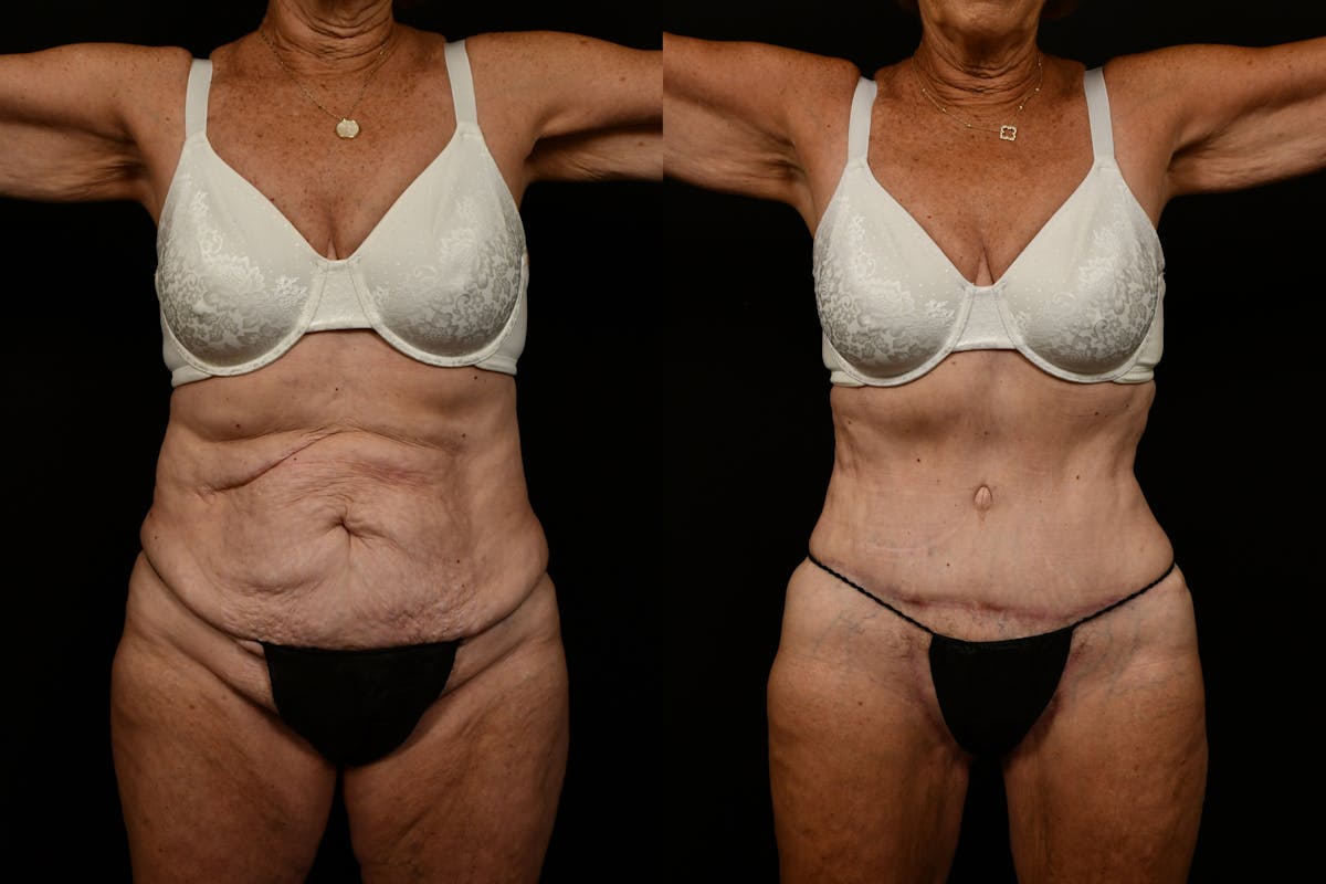 Tummy Tuck Before & After Gallery - Patient 258196 - Image 1