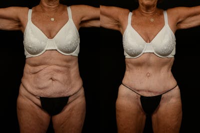 Tummy Tuck Before & After Gallery - Patient 258196 - Image 1