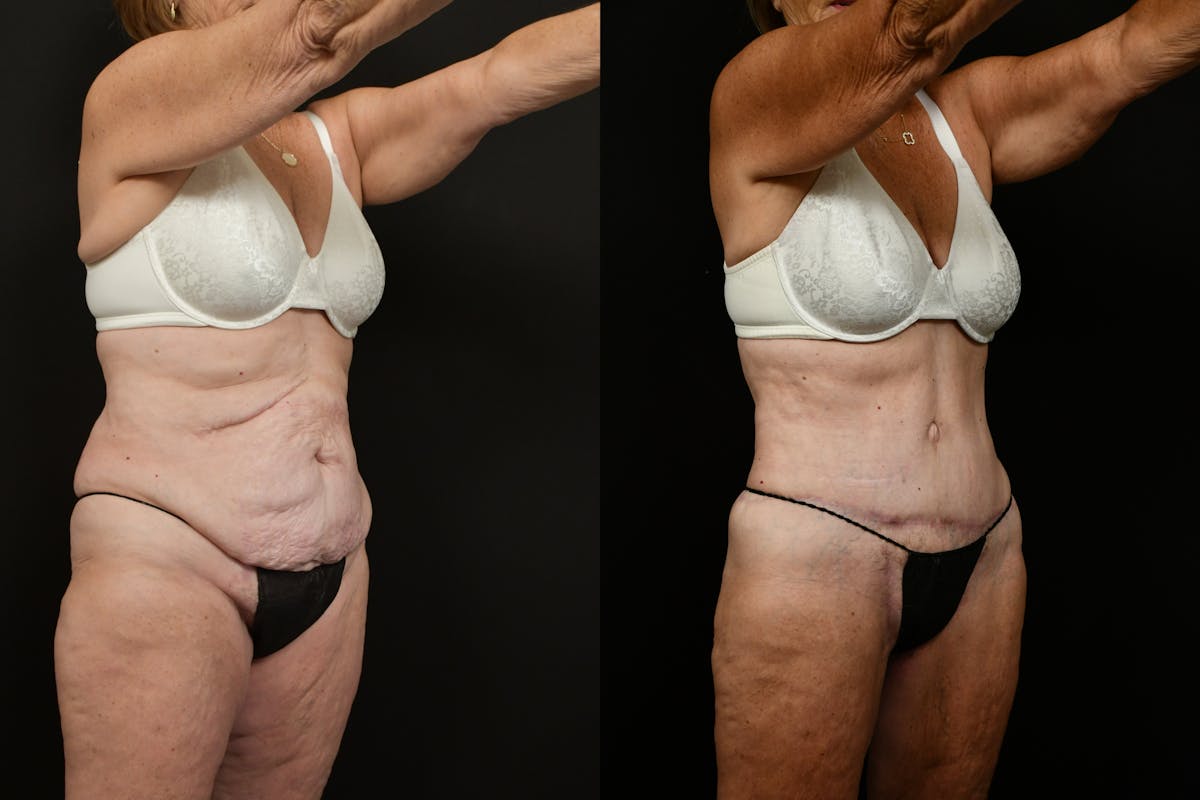 Tummy Tuck Before & After Gallery - Patient 258196 - Image 2