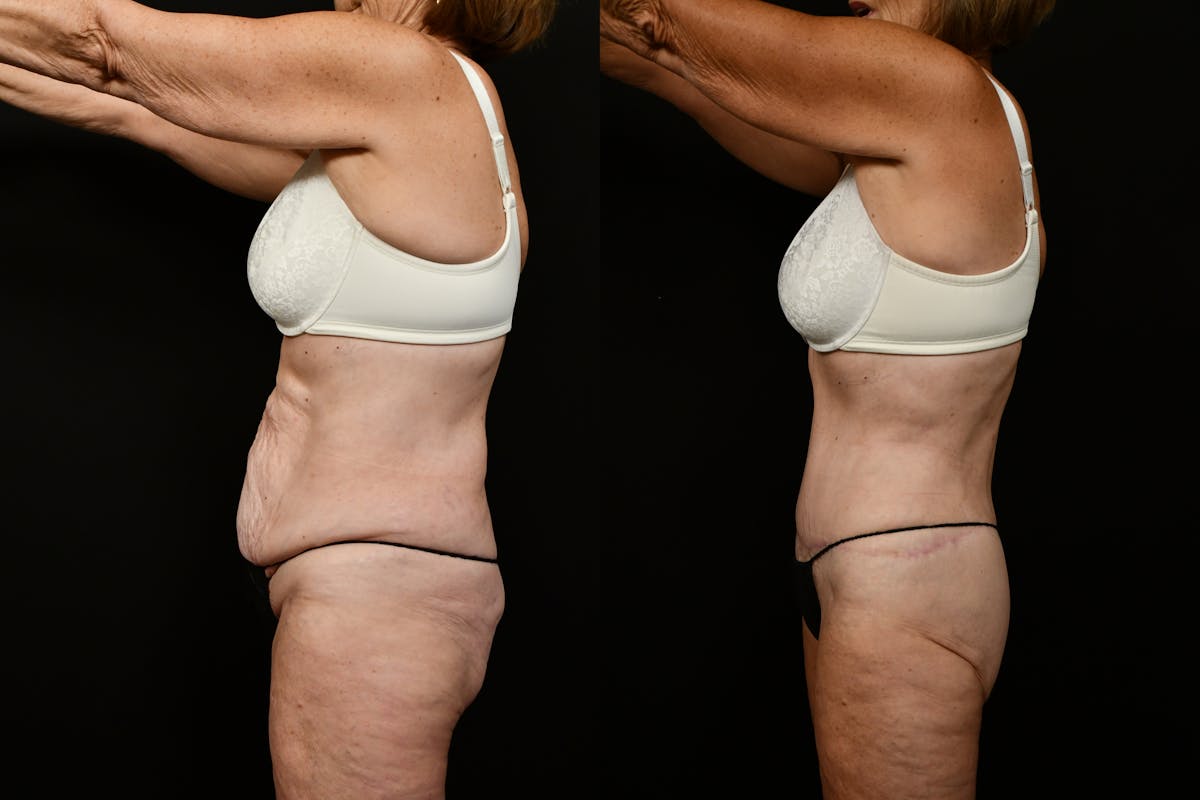 Tummy Tuck Before & After Gallery - Patient 258196 - Image 7