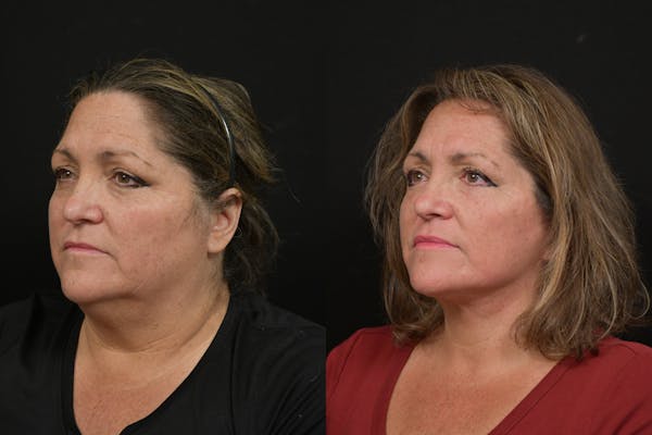 Neck Lift Before & After Gallery - Patient 416536 - Image 1
