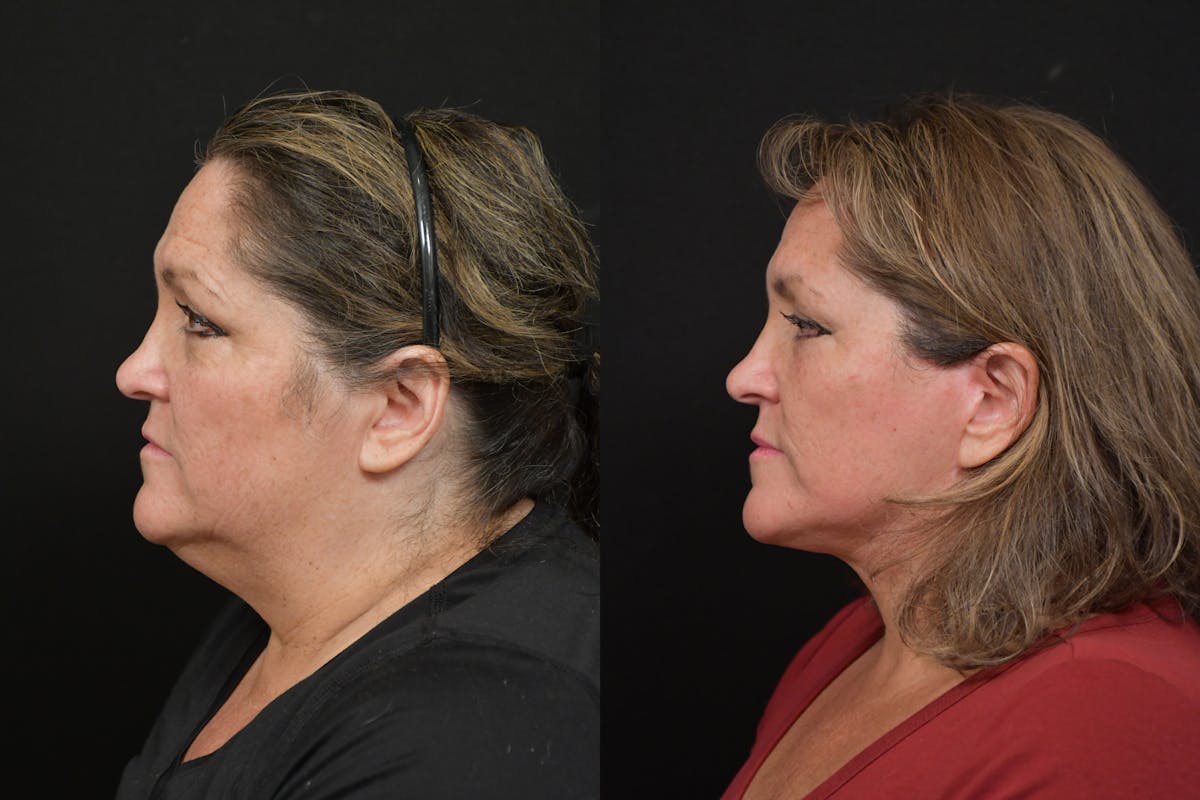 Neck Lift Before & After Gallery - Patient 416536 - Image 2