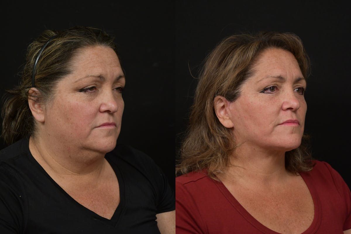 Neck Lift Before & After Gallery - Patient 416536 - Image 3