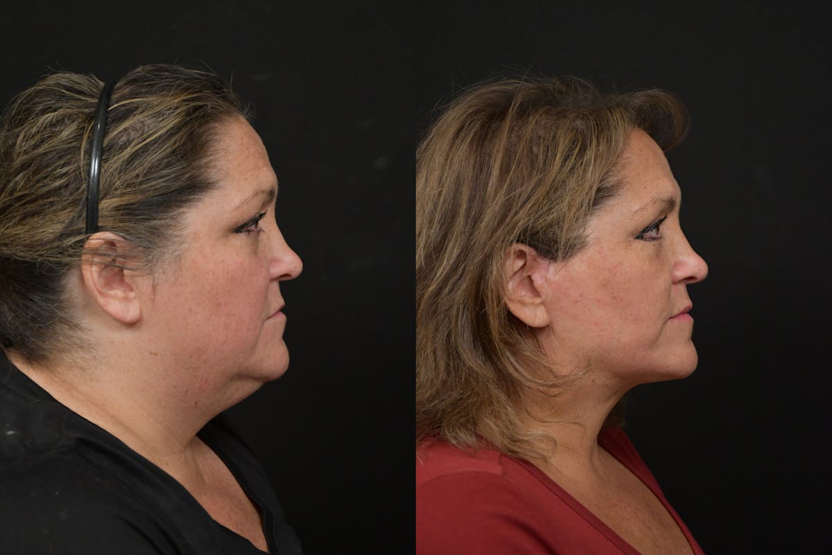 Neck Lift Before & After Gallery - Patient 416536 - Image 4