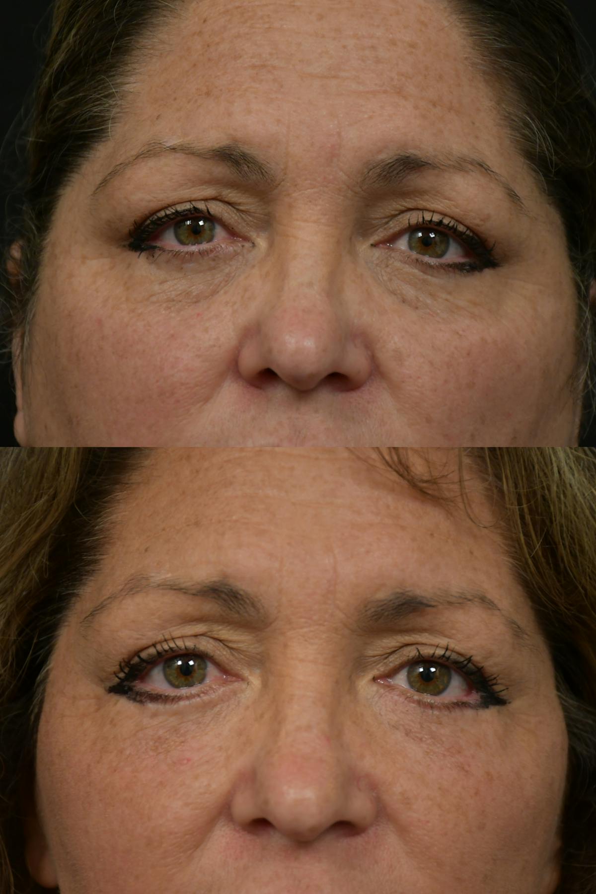 Eyelid Surgery Before & After Gallery - Patient 127260 - Image 2