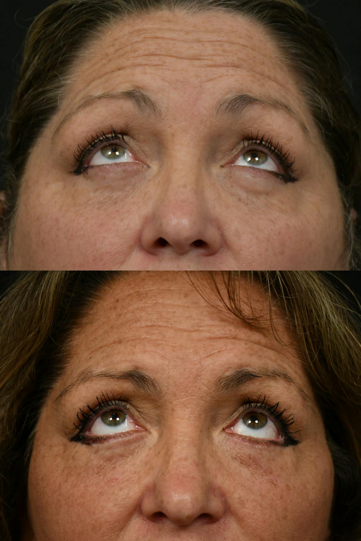 Eyelid Surgery Before & After Gallery - Patient 127260 - Image 4