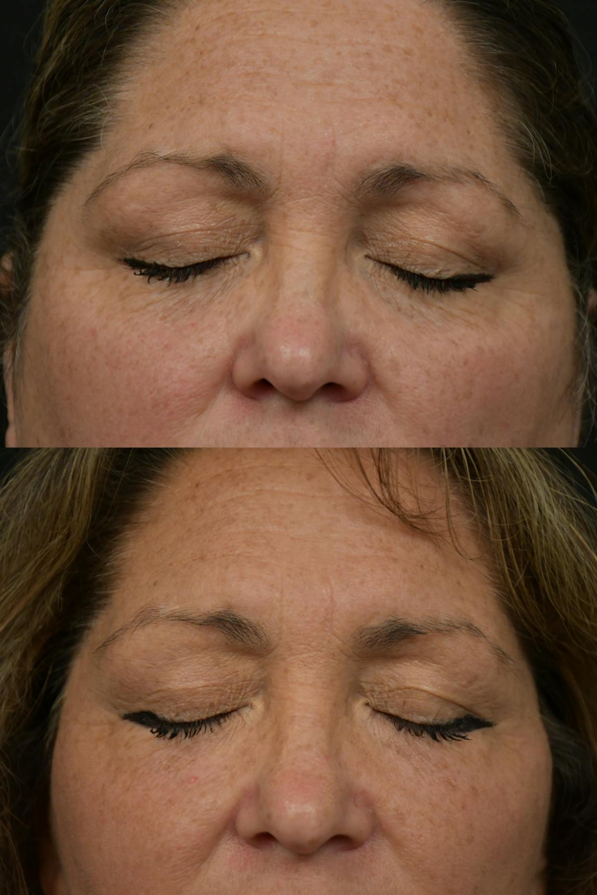 Eyelid Surgery Before & After Gallery - Patient 127260 - Image 3