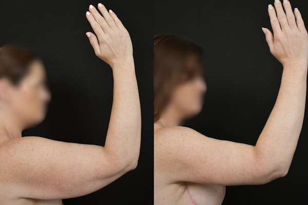 Arm Lift Before & After Gallery - Patient 146320 - Image 1