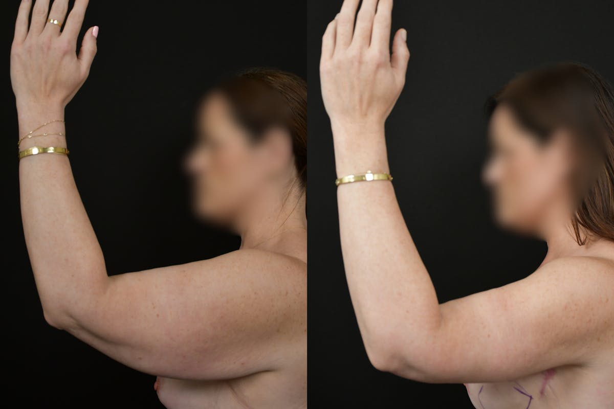 Arm Lift Before & After Gallery - Patient 146320 - Image 2