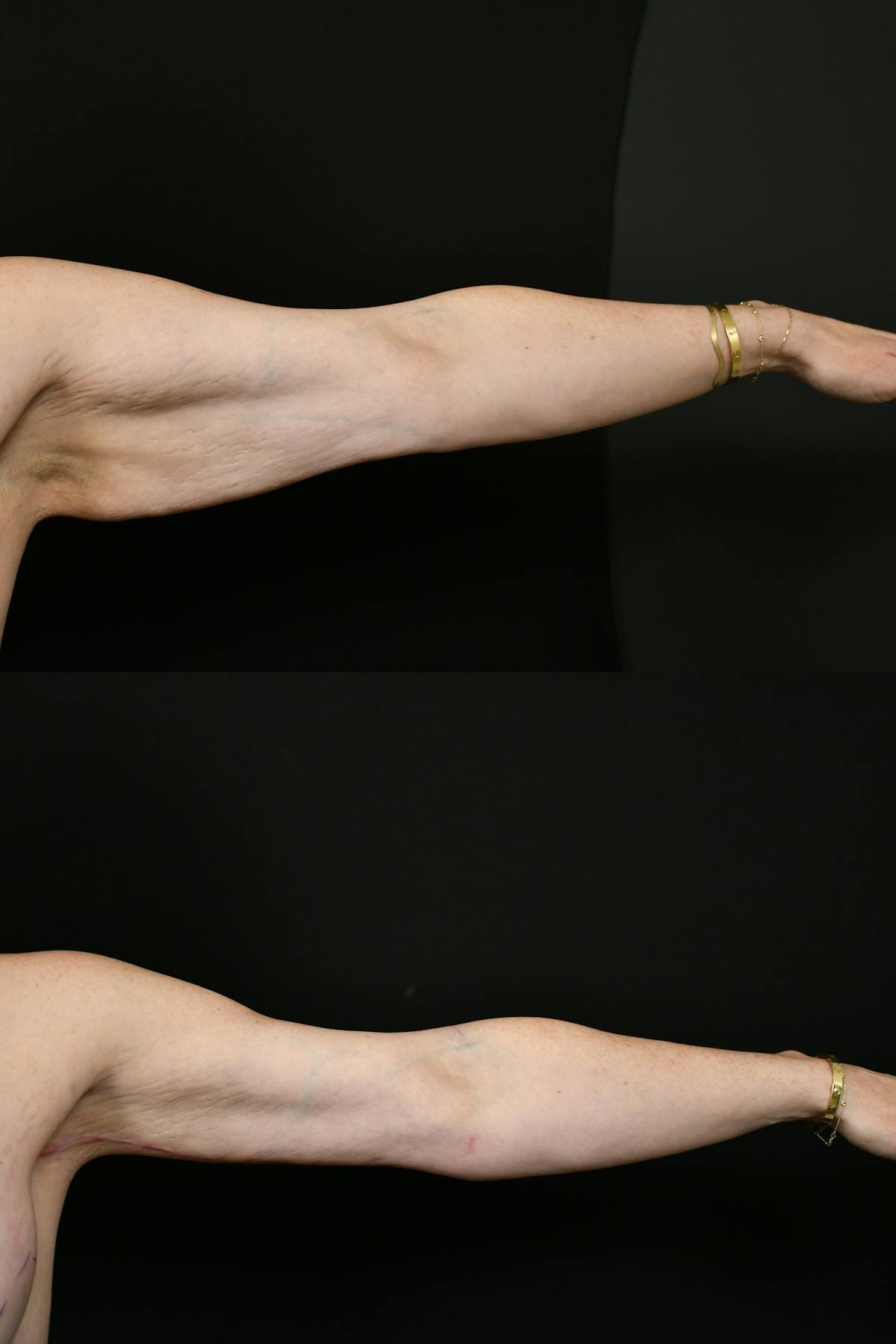 Arm Lift Before & After Gallery - Patient 146320 - Image 3