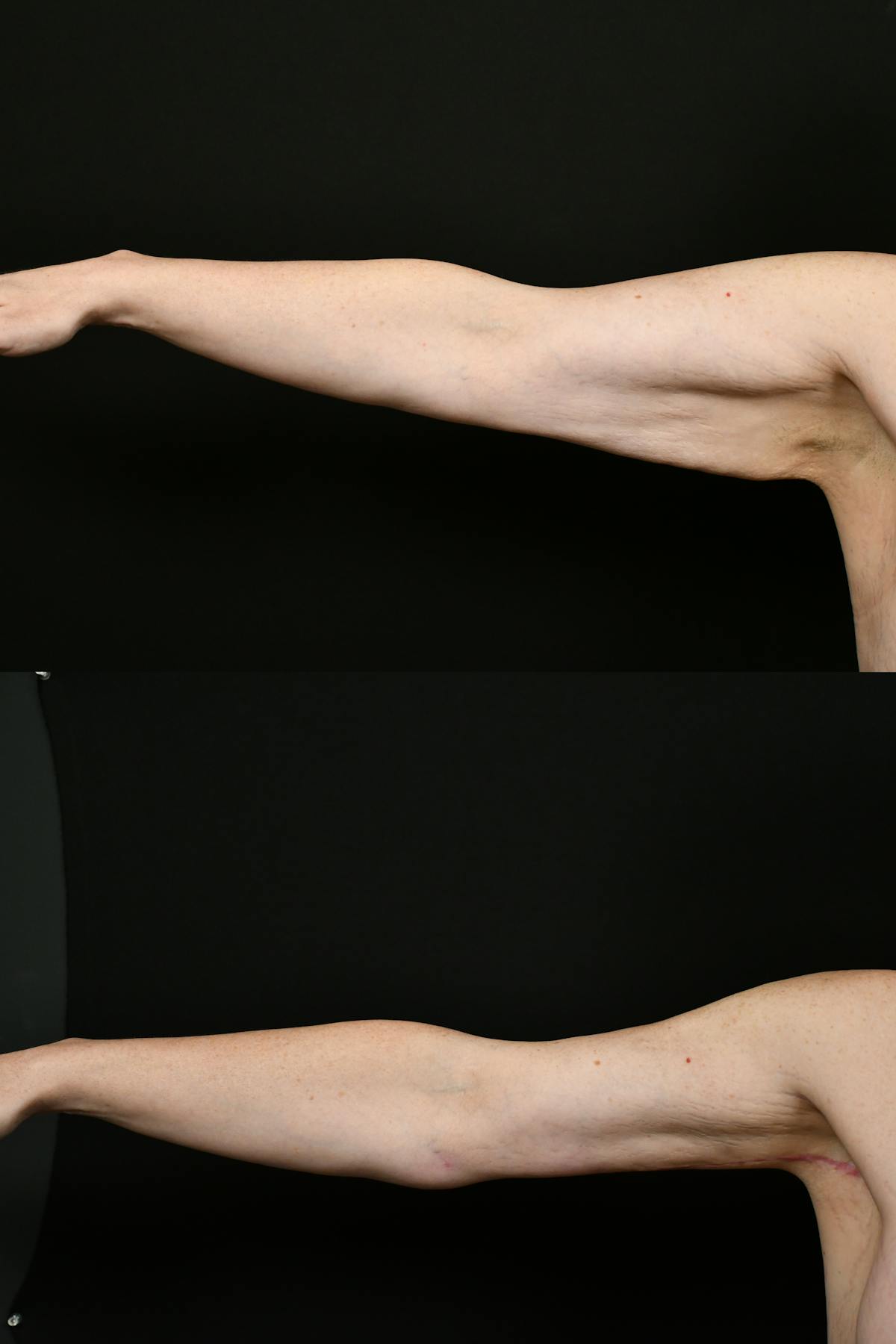 Arm Lift Before & After Gallery - Patient 146320 - Image 4
