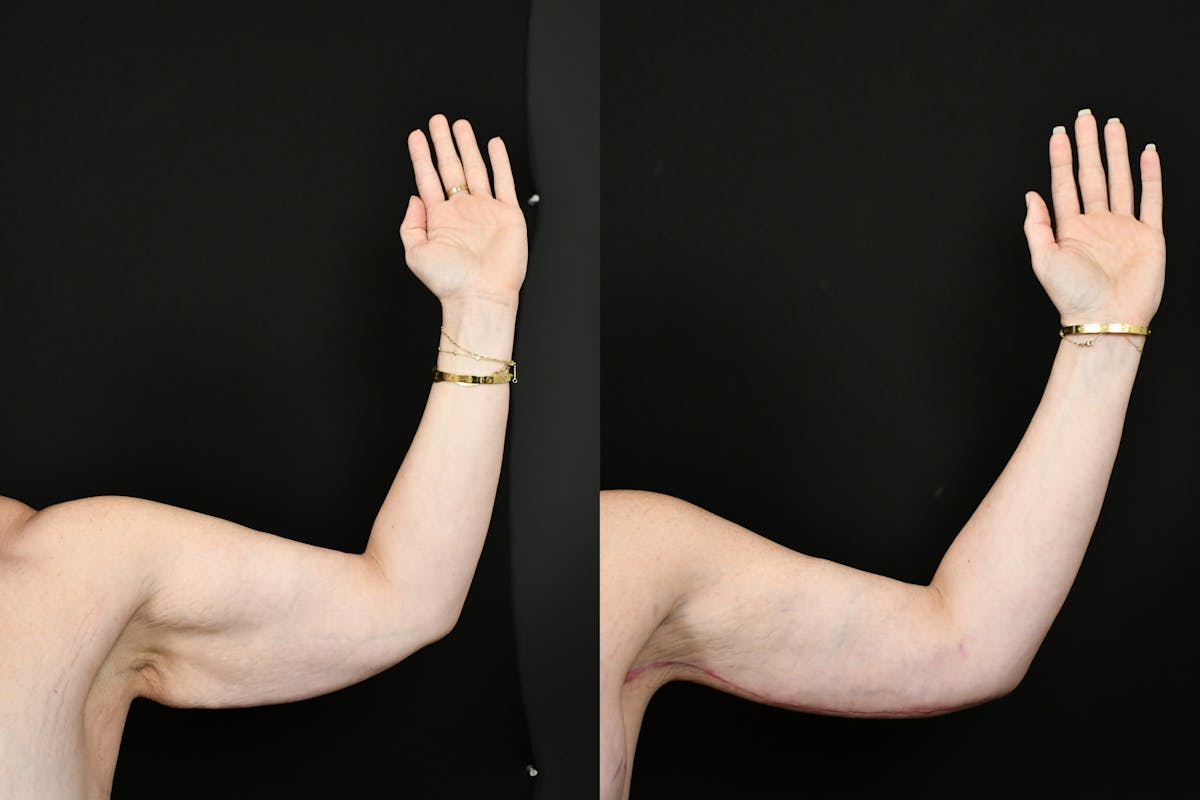 Arm Lift Before & After Gallery - Patient 146320 - Image 5