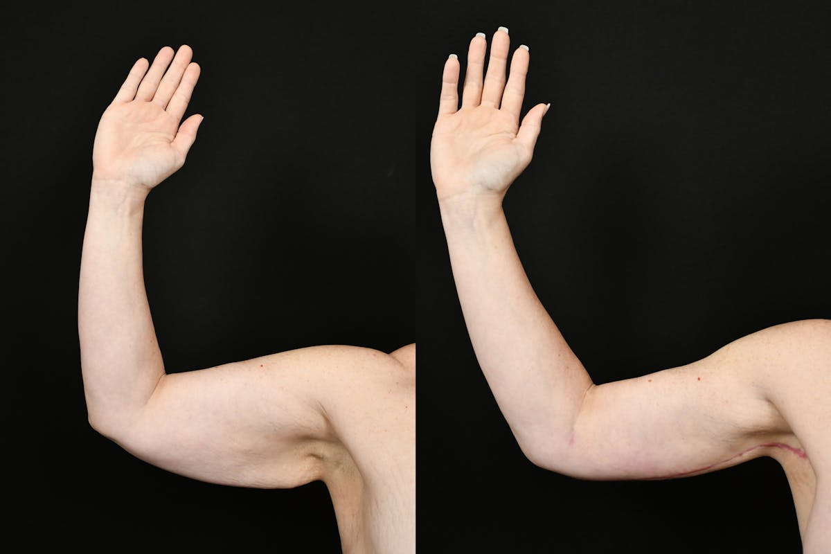 Arm Lift Before & After Gallery - Patient 146320 - Image 6