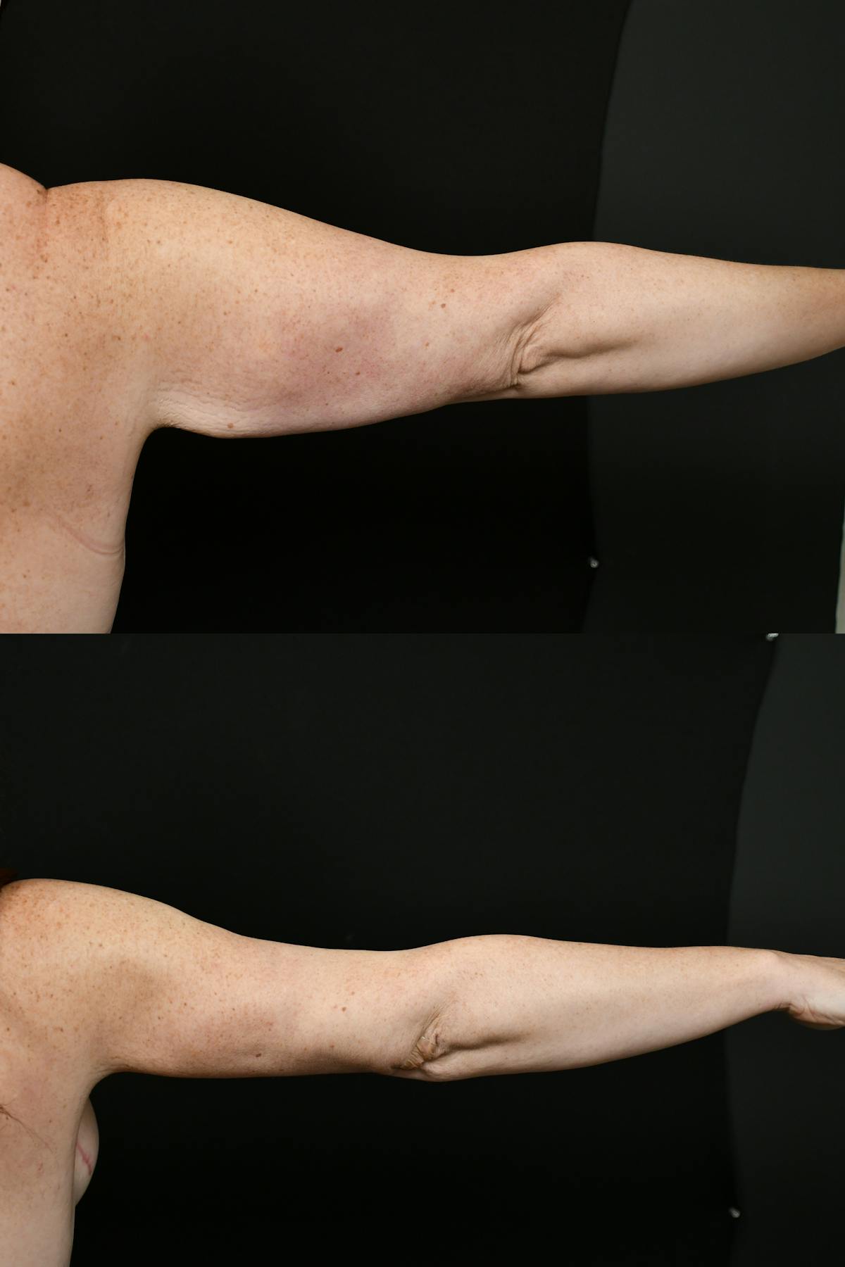 Arm Lift Before & After Gallery - Patient 146320 - Image 8