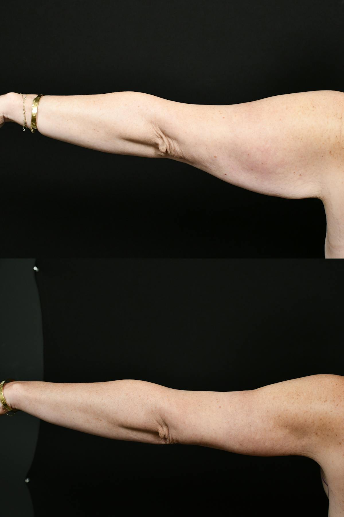 Arm Lift Before & After Gallery - Patient 146320 - Image 7