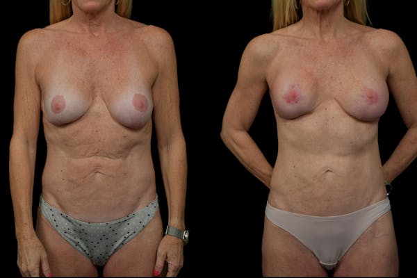 Reverse Tummy Tuck Before & After Gallery - Patient 229328 - Image 1