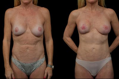 Reverse Tummy Tuck Before & After Gallery - Patient 229328 - Image 1