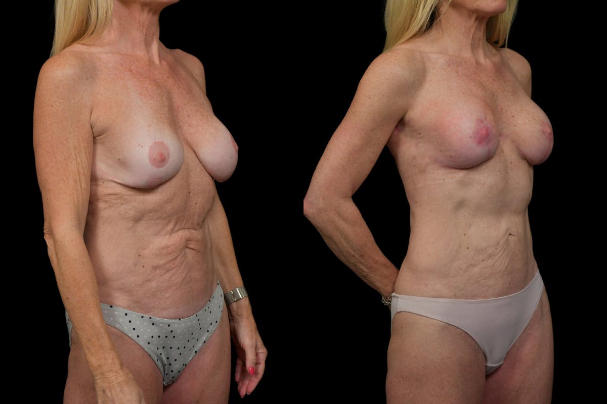 Reverse Tummy Tuck Before & After Gallery - Patient 229328 - Image 4