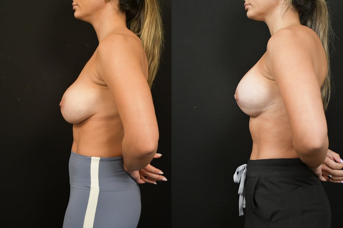 Breast Revision Before & After Gallery - Patient 293638 - Image 5