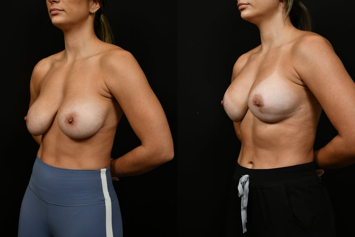 Breast Revision Before & After Gallery - Patient 293638 - Image 4