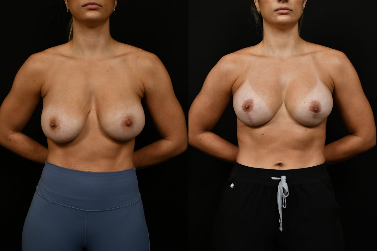 Breast Revision Before & After Gallery - Patient 293638 - Image 1