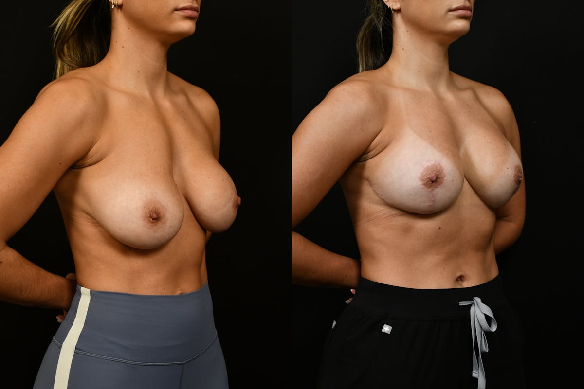 Breast Revision Before & After Gallery - Patient 293638 - Image 2