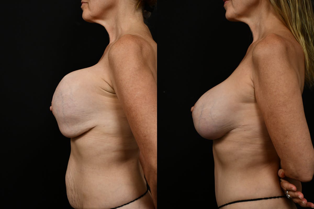 Breast Revision Before & After Gallery - Patient 481336 - Image 3