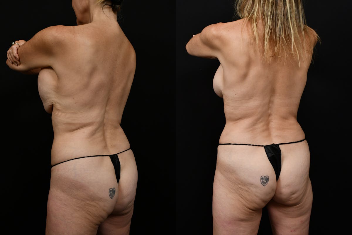 Tummy Tuck Before & After Gallery - Patient 116791 - Image 6