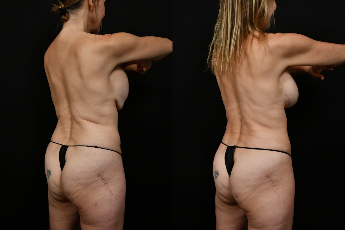 Tummy Tuck Before & After Gallery - Patient 116791 - Image 4