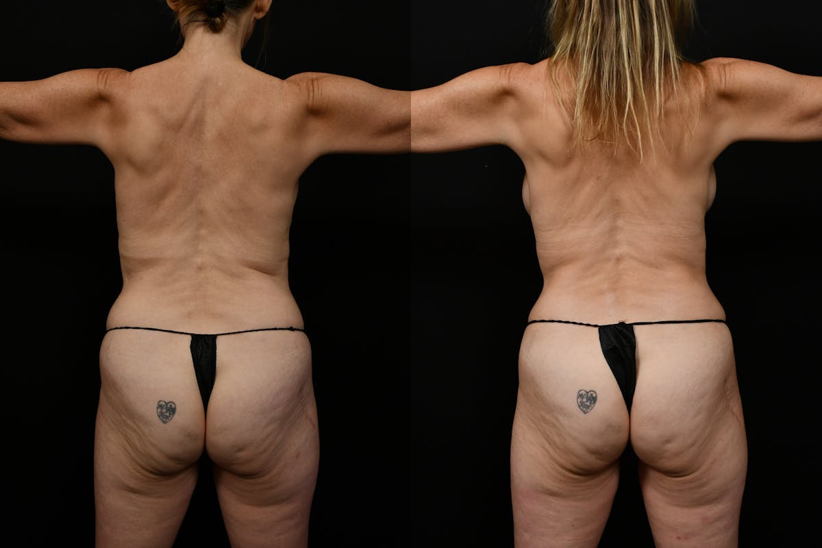 Tummy Tuck Before & After Gallery - Patient 116791 - Image 5