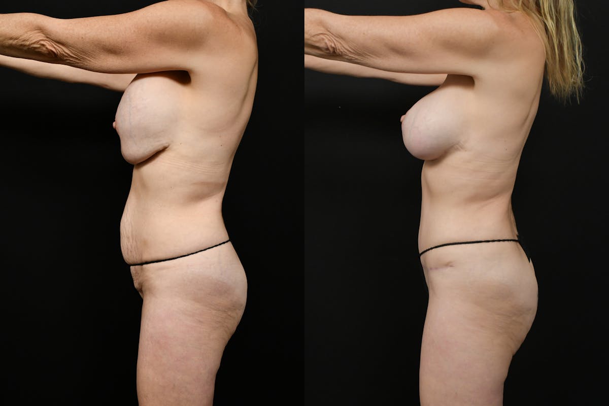 Tummy Tuck Before & After Gallery - Patient 116791 - Image 7