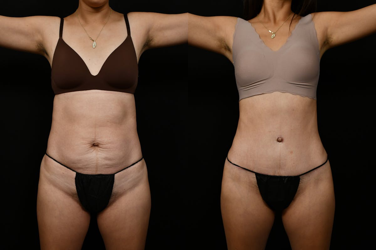 Tummy Tuck Before & After Gallery - Patient 144541 - Image 1