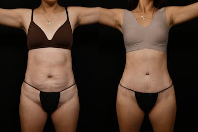 Tummy Tuck Before & After Gallery - Patient 144541 - Image 1