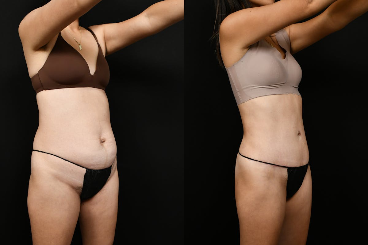 Tummy Tuck Before & After Gallery - Patient 144541 - Image 2