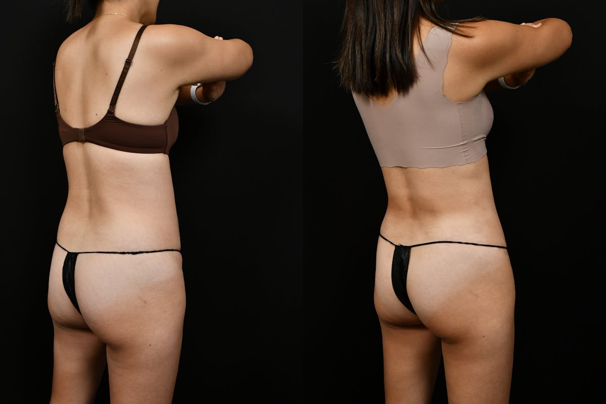 Tummy Tuck Before & After Gallery - Patient 144541 - Image 4