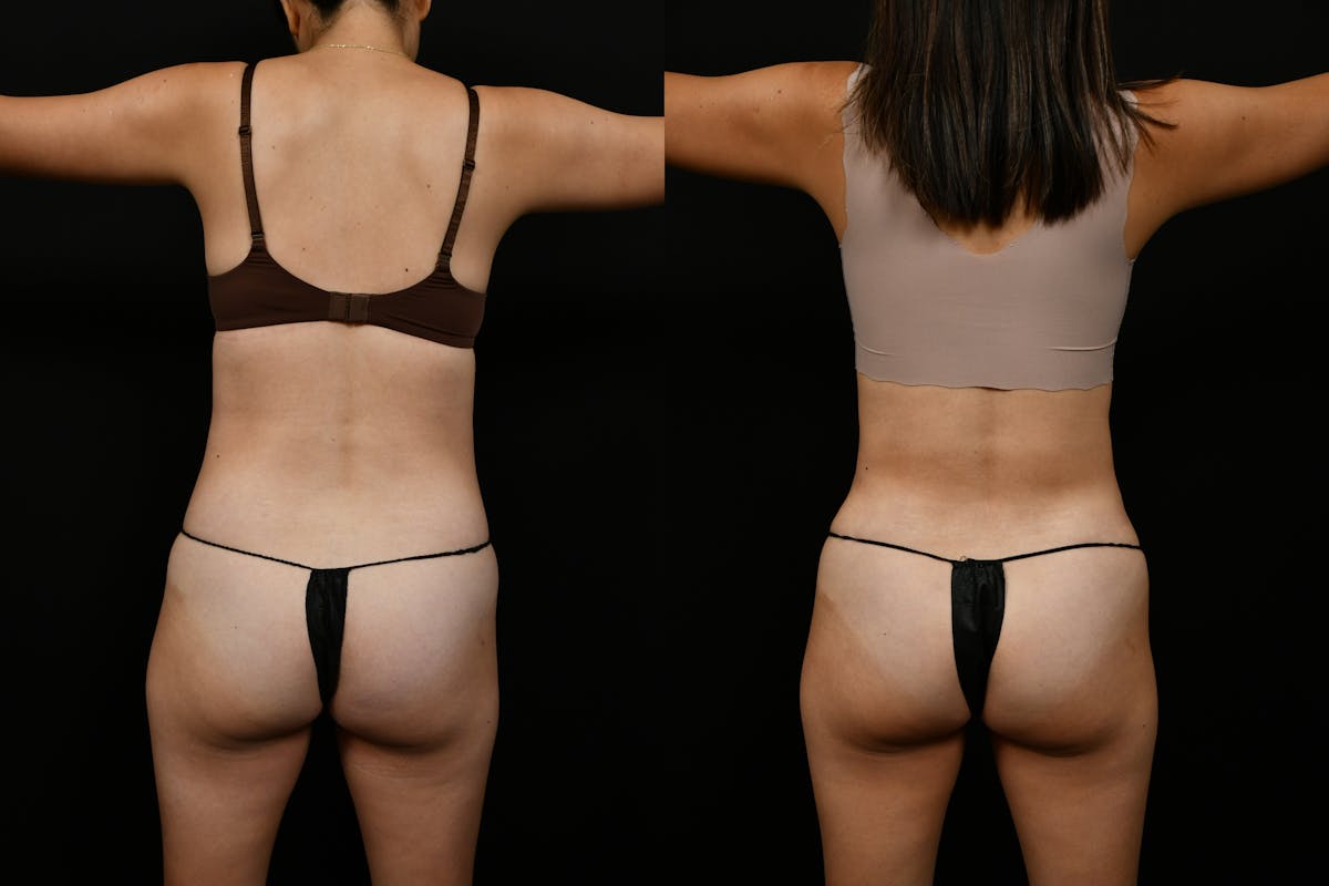 Tummy Tuck Before & After Gallery - Patient 144541 - Image 5