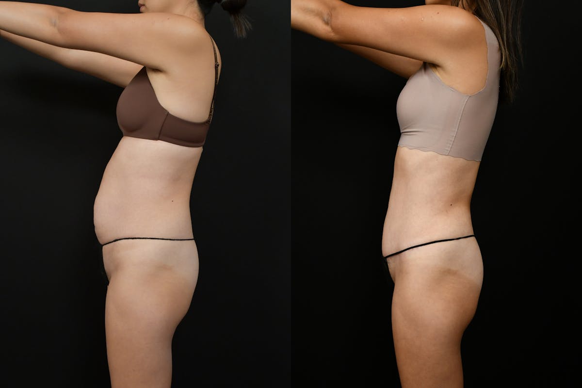 Tummy Tuck Before & After Gallery - Patient 144541 - Image 7