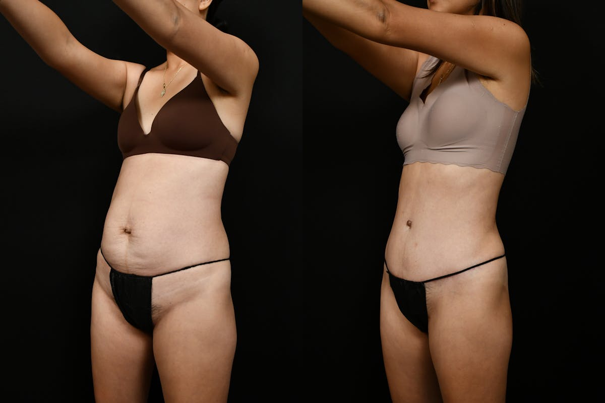 Tummy Tuck Before & After Gallery - Patient 144541 - Image 8