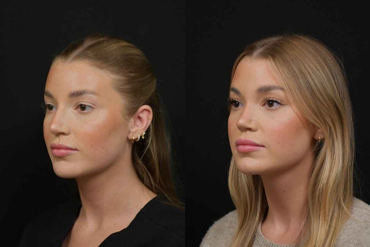 Rhinoplasty Before & After Gallery - Patient 248359 - Image 1