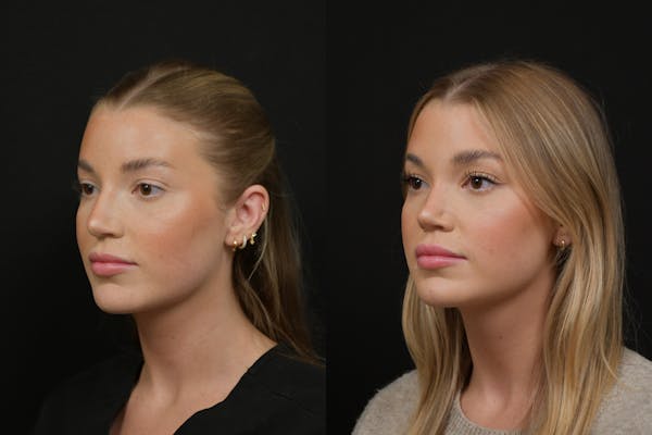 Rhinoplasty Before & After Gallery - Patient 248359 - Image 1