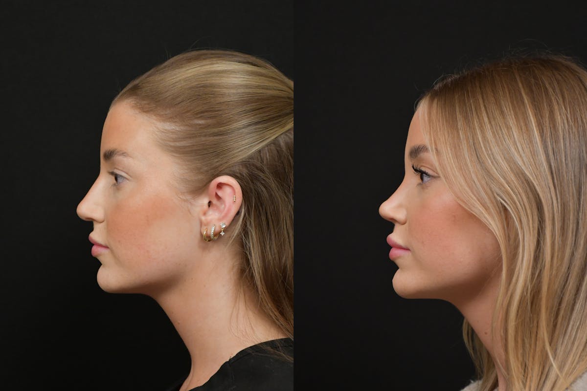 Rhinoplasty Before & After Gallery - Patient 248359 - Image 2