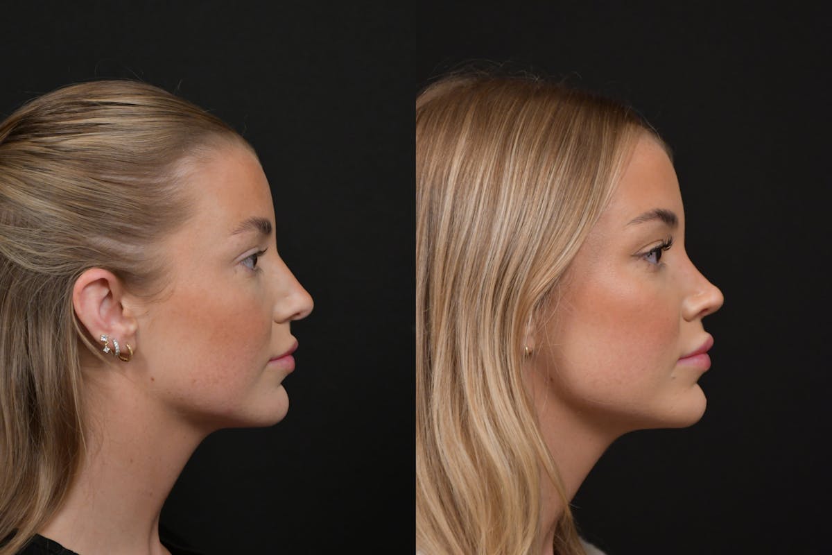 Rhinoplasty Before & After Gallery - Patient 248359 - Image 4