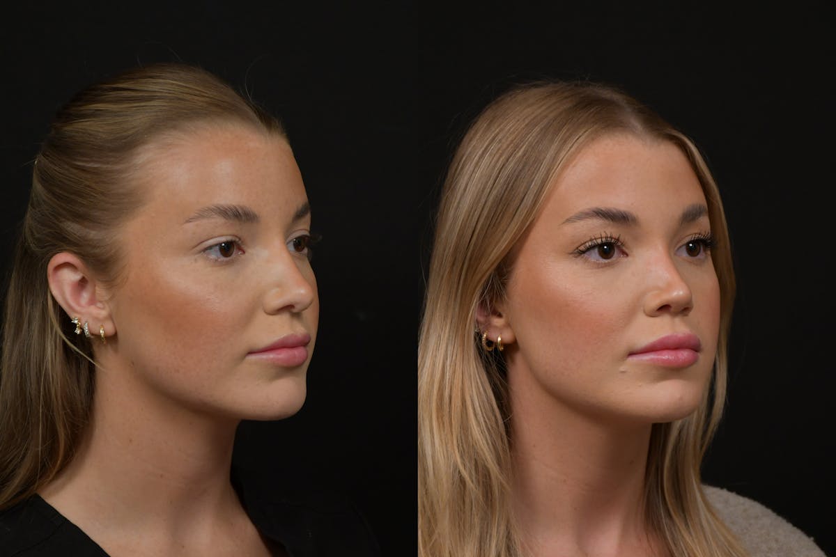 Rhinoplasty Before & After Gallery - Patient 248359 - Image 3