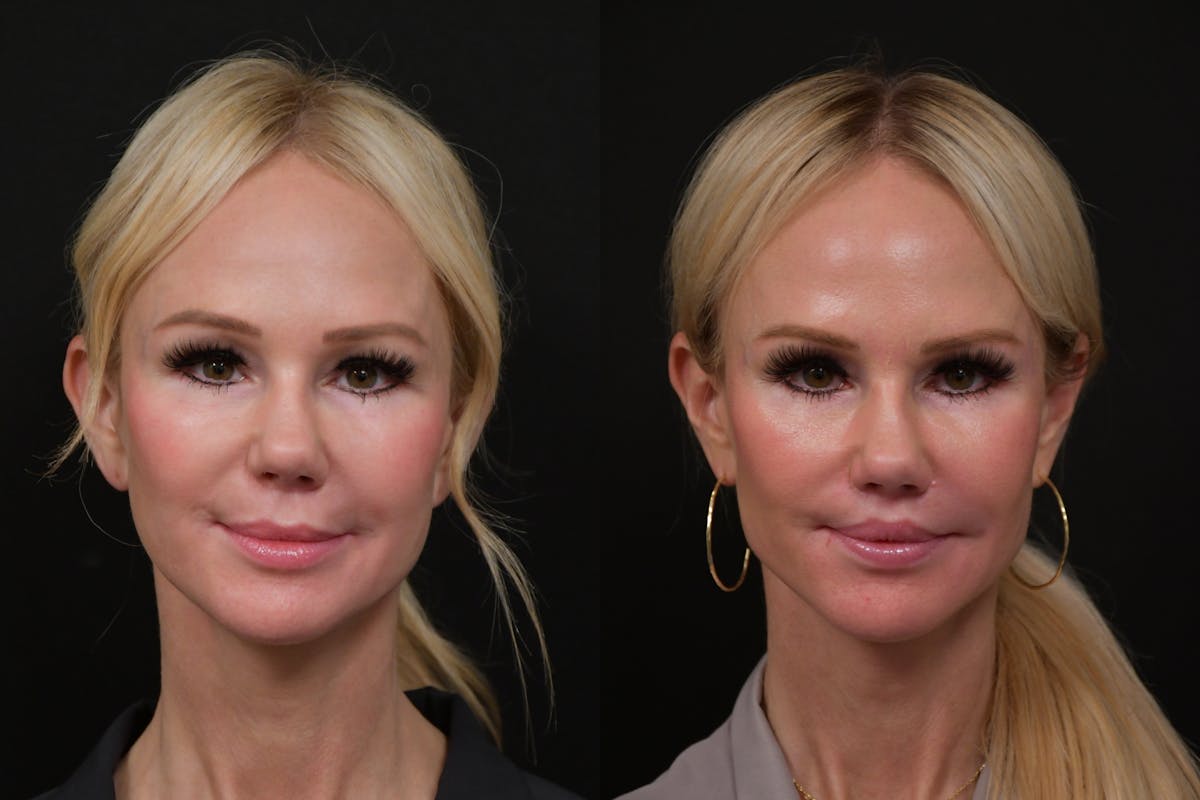 Lip Lift Before & After Gallery - Patient 366641 - Image 1