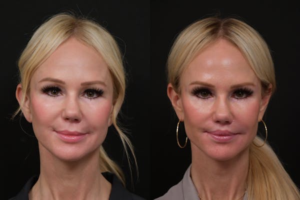Lip Lift Before & After Gallery - Patient 366641 - Image 1